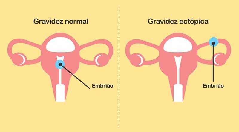 O Que é Uma Gravidez Ectópica?