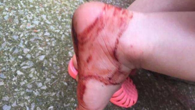 Atenção com as sandálias de plástico, veja o que aconteceu com essa menina!