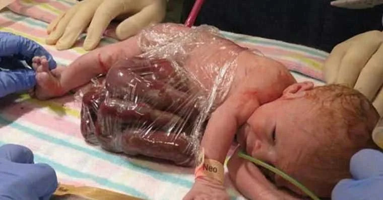 medico aconselhou mae a abortar mas ela nao fez veja como ele nasceu