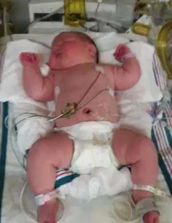 bebe nasce com mais de 6kg e impressiona medicos