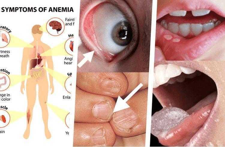 Conheça 8 sinais de alerta de anemia