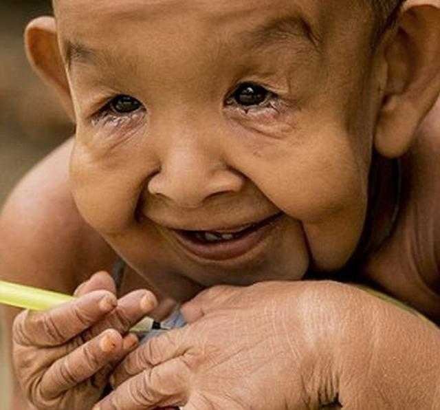 Menino de 4 anos com aparencia de idoso abandona escola