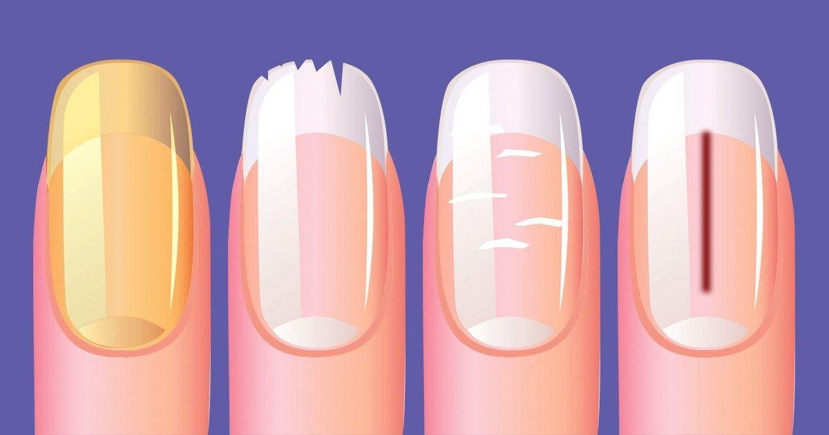 As unhas podem revelar sintomas de cinco doenças graves, entre elas o câncer