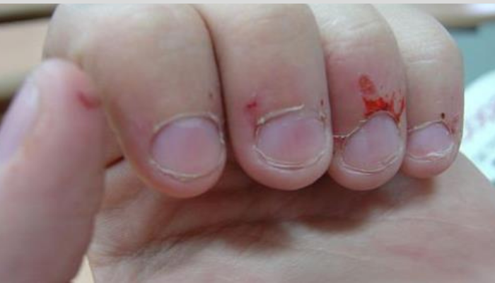 compulsao em roer unhas e sinal de alerta