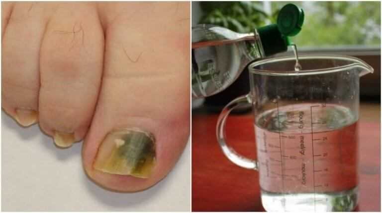 Água oxigenada para prevenir fungos das unhas fr