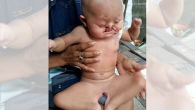 bebe sereia luta para conseguir tratamento contra sindrome rara (1)