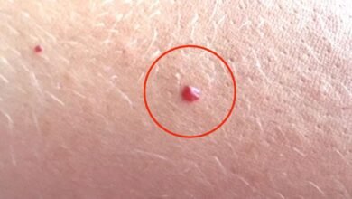 se você tem essas pintas no corpo, saiba por que esse é um problema que não pode ser ignorado