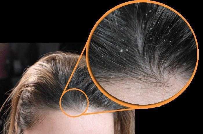 12 coisas que dão caspa e você não sabia