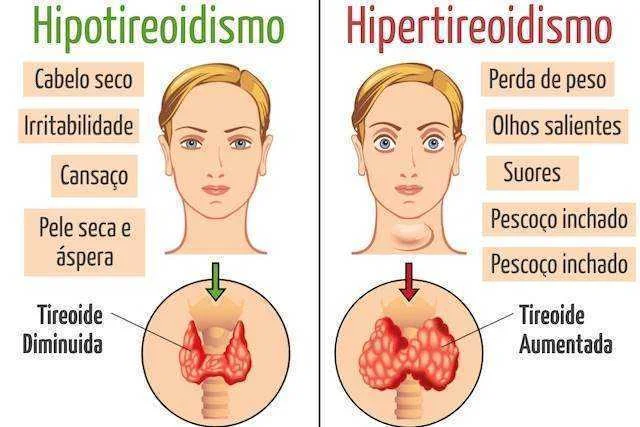 14 sinais que indicam problemas na tireoide
