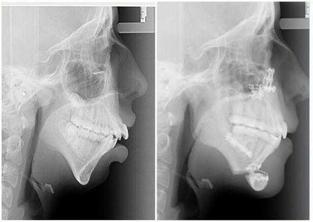 Ela Tinha uma Deformação na Mandíbula e a Cirurgia ficou INCRÍVEL
