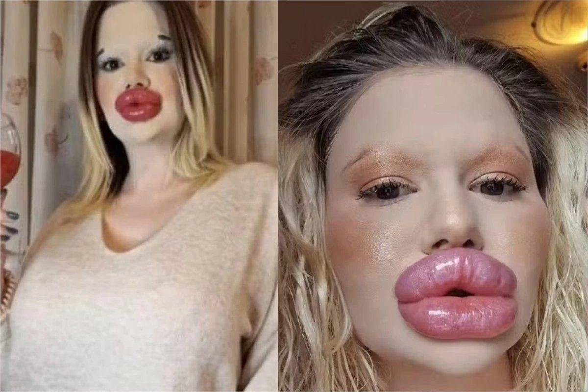 Mulher com os ‘maiores lábios’ do mundo quer passar por outra transformação