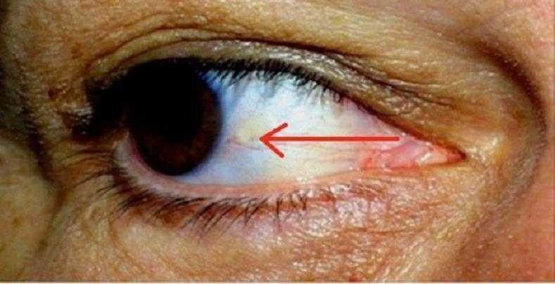 Os seus olhos podem indicar que está prestes a ter um ataque cardíaco