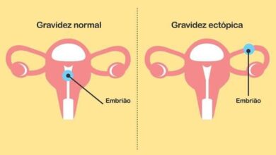 O Que é Uma Gravidez Ectópica?