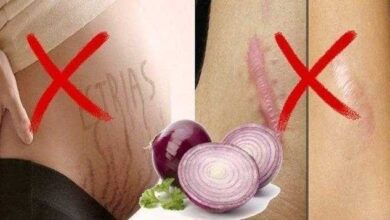 1749186814 Cebola para eliminar estrias e cicatrizes Cebola para eliminar estrias e cicatrizes
