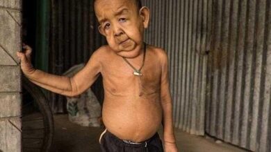 Menino de 4 anos com aparência de idoso abandona escola por causar medo