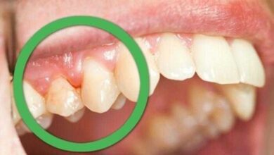 1749214508 Como Curar Gengivite Naturalmente Bau das DICAS Como Curar Gengivite Naturalmente
