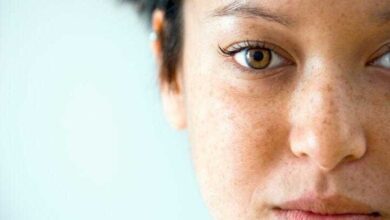 Remédios Caseiros Para Sardas