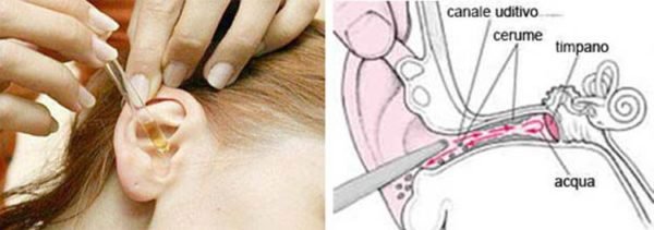 1749260574 65 Vejam porque voce nao deve limpar os ouvidos com o