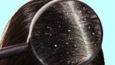 Os melhores remédios caseiros para acabar com a caspa