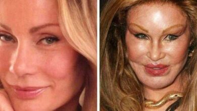 Veja as cirurgias plásticas que mais deram errado na história humana