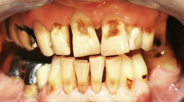 1749518224 46 9 Sinais de que seu corpo esta implorando por uma problemas-dentais-da-bulimia-7