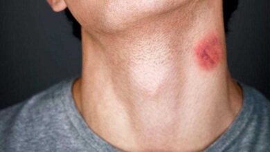 Chupões podem ser fatais. Entenda por quê