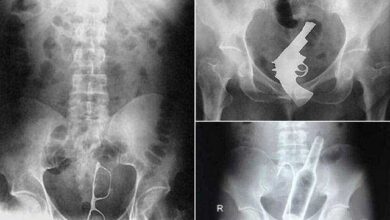 1749690188 11 objetos estranhos encontrados dentro das pessoas 11 objetos estranhos encontrados dentro das pessoas