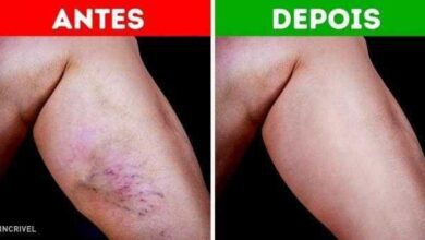 Confira 4 remédios naturais para as varizes