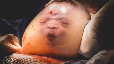 Parto raro acontece no ES e nasce bebê dentro da bolsa amniótica