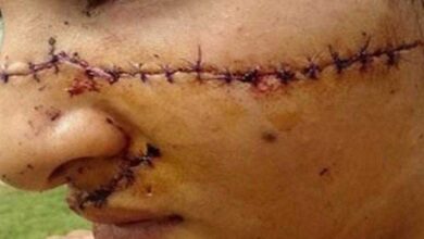 Adolescente tem rosto desfigurado por vizinhas que a achavam bonita demais