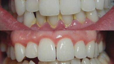 Prepare este remédio e diga adeus ao tártaro rf