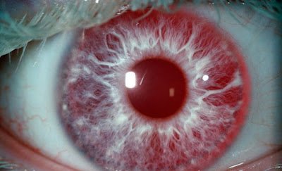1749733388 252 As 5 cores de olhos mais raras do mundo olhos vermelhos