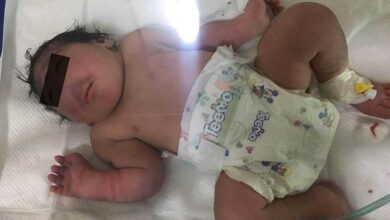 Bebê nasce sem nariz em caso raríssimo! Veja e entenda: