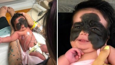 Bebê é chamada de monstro por causa de sua aparência e mãe desabafa