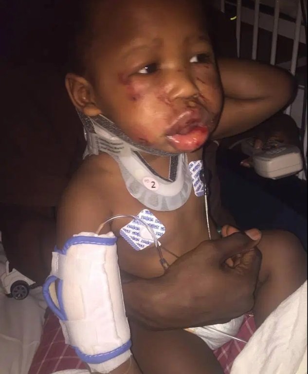 1749785888 740 Bebe e agredido na creche mae mostra machucados e desabafa blank