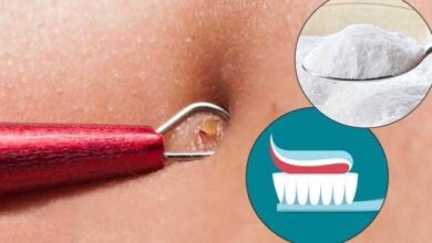 Receita caseira para tirar cravos e espinhas em 2 minutos d