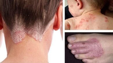 5 remédios totalmente naturais para acabar com eczema, psoríase e outras doenças de pele