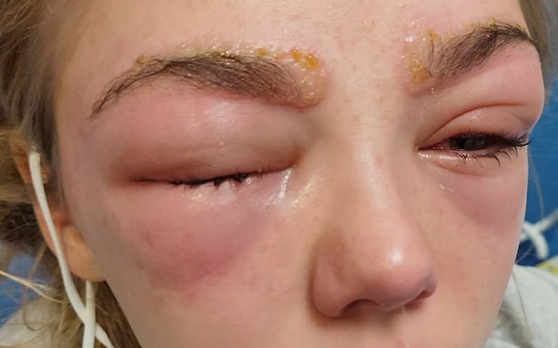 1749911353 109 Jovem quase perde a vida ao realizar procedimento que muitas 'i was screaming in pain': girl, 14, 'almost loses eyesight' after severe allergic reaction to eyebrow treatment