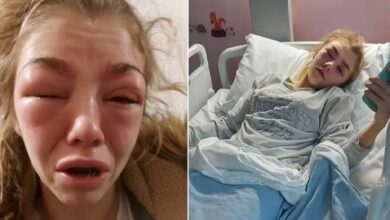 Jovem quase perde a vida ao realizar procedimento que muitas mulheres fazem nas sobrancelhas: 'Foi horrível'