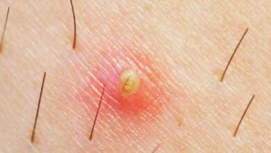 5 tratamentos caseiros para pelos encravados