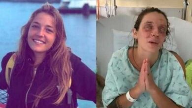 Jovem fica cega ao ter os olhos queimados por maquiagem caseira