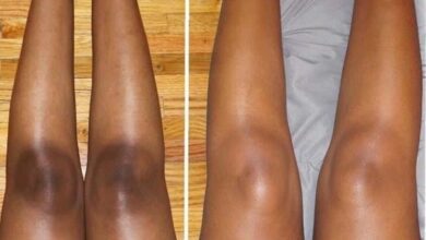 Receita Caseira Para Remover Manchas do Joelho