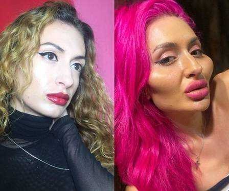 1750305201 712 Mulher viciada em preenchimento fica irreconhecivel apos mudanca bizarra