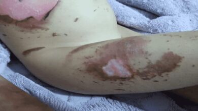 Celular explode e menina de 5 anos sofre queimaduras