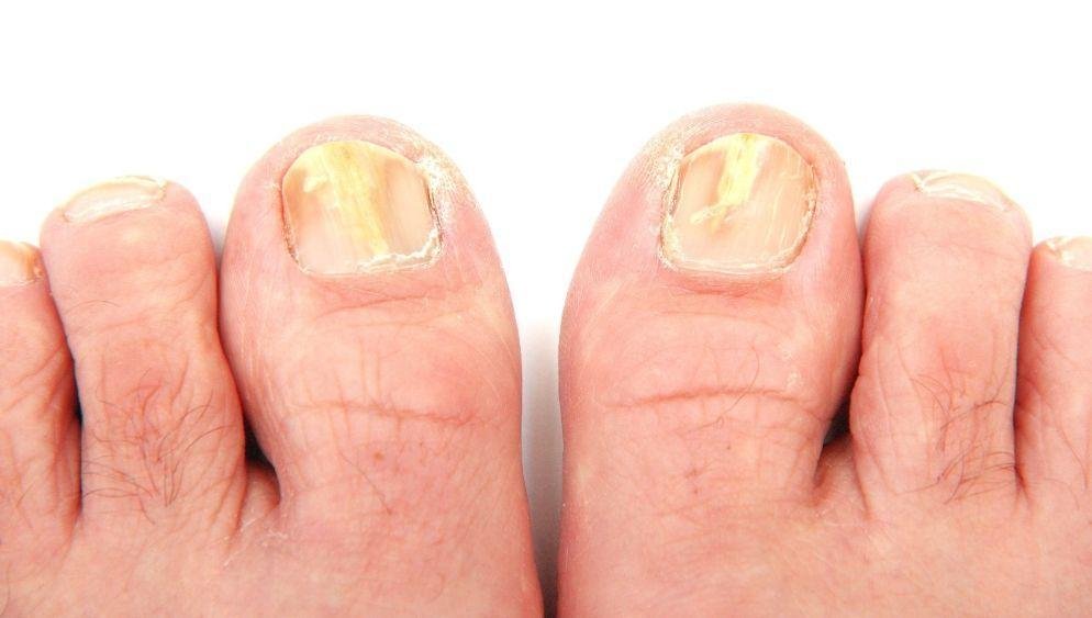 Elimine rapidamente os fungos dos pés e das mãos com essa receita!
