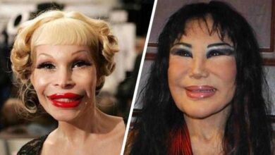 10 Pessoas que exageraram no botox