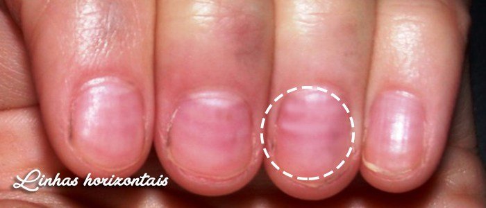 1750383321 513 Suas unhas se encontram com algum destes aspectos CUIDADO para unhas4