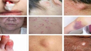 15 Sinais perigosos de câncer que as pessoas ignoram