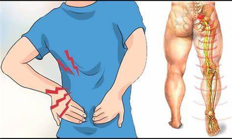 1750401972 nervo ciatico inflamado %E2%80%93 sintomas e tratamento Nervo Ciático Inflamado – Sintomas E Tratamento