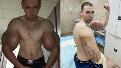 Homem que injetou óleo para ficar “forte” enfrenta cirurgias para evitar amputação dos braços